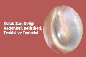 Kulak Zarı Deliği Nedenleri, Belirtileri, Teşhisi ve Tedavisi