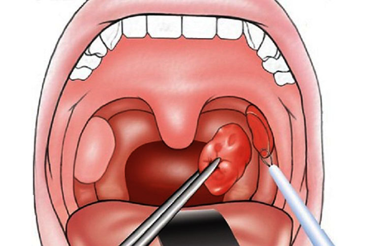 Bademcik ameliyatı - tonsillektomi